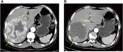 Prediction of initial objective response to drug-eluting beads transcatheter arterial chemoembolization for hepatocellular carcinoma using CT radiomics-based machine learning model